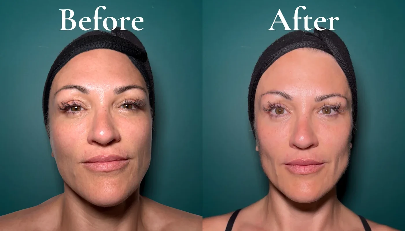 Before and after the RRR Face lymphatic facial, showing a more defined, less puffy face