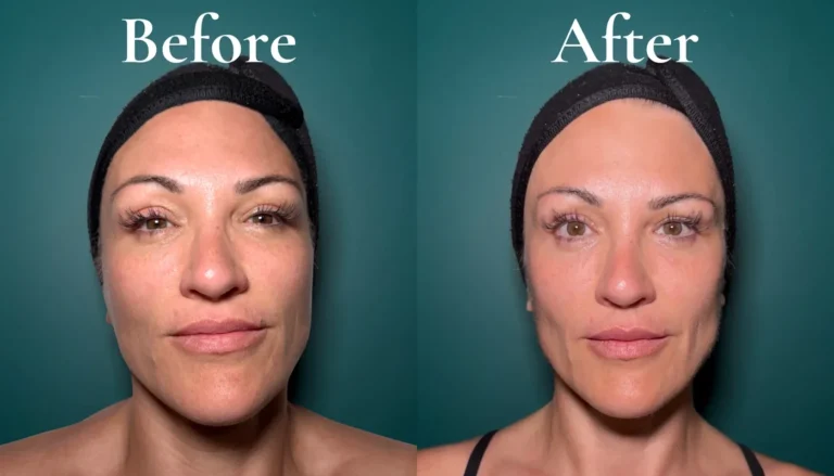 Before and after the RRR Face lymphatic facial, showing a more defined, less puffy face